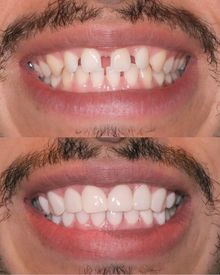 Snap On Smile Veneers Teeth For Men And Women